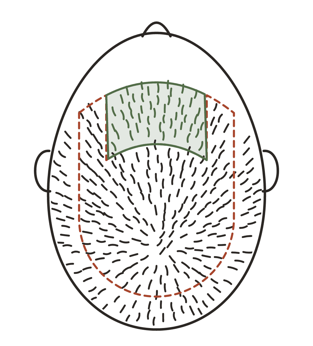 A head seen from above just after a hair transplant. A band of transplanted hair behind the hairline is shaded and outlined with a solid line; the native hair around it, outlined with a dashed line, is still full.
